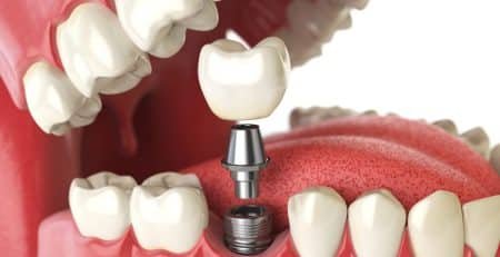 dental implant clinic in Noida