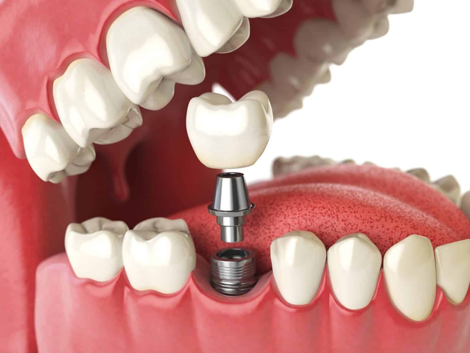 dental implant clinic in Noida