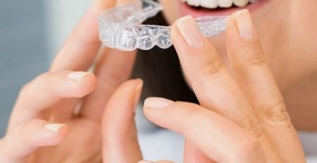 teeth Aligners treatment in noida