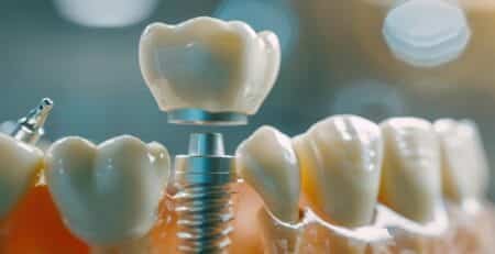 Best Dental Implants