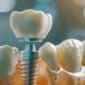 Best Dental Implants