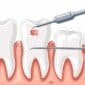 Best Root Canal Treatment in Noida