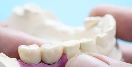 Dental Crowns and Bridges